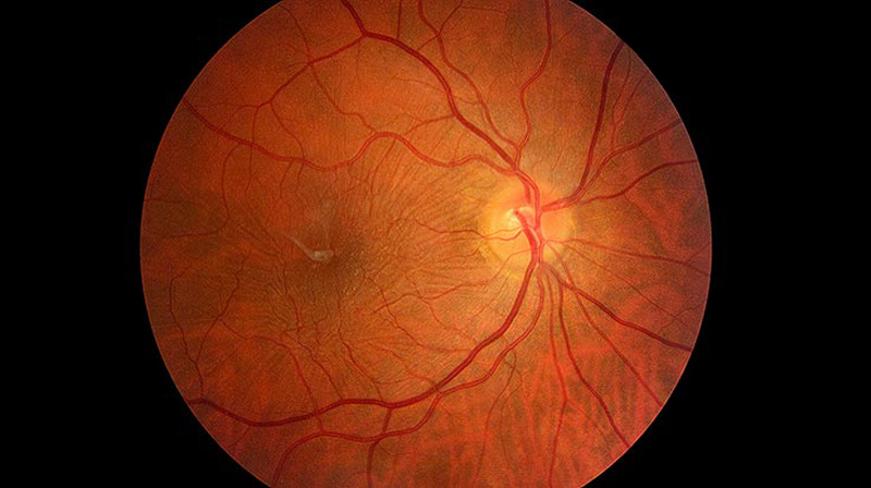 Epiretinal Membran