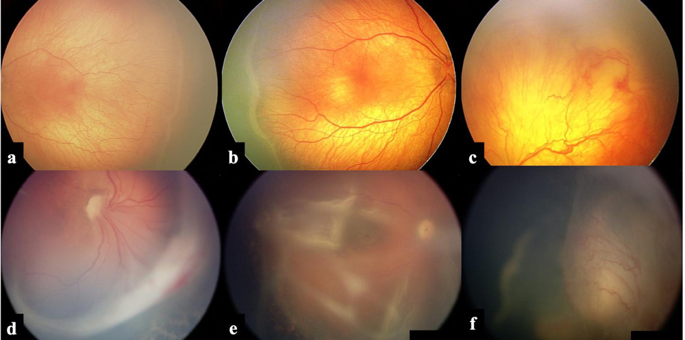 Prematüre retinopatisi