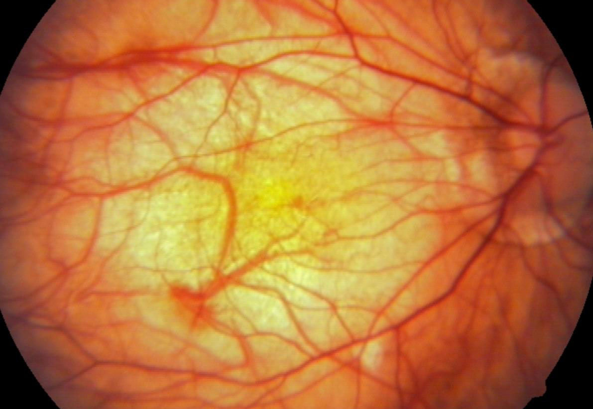 retina cerrahisi