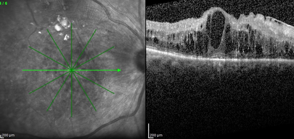 diyabetik retinopati nedir